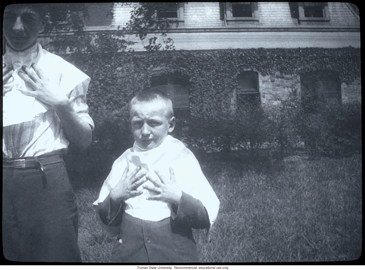 Two boys with polydactyly.