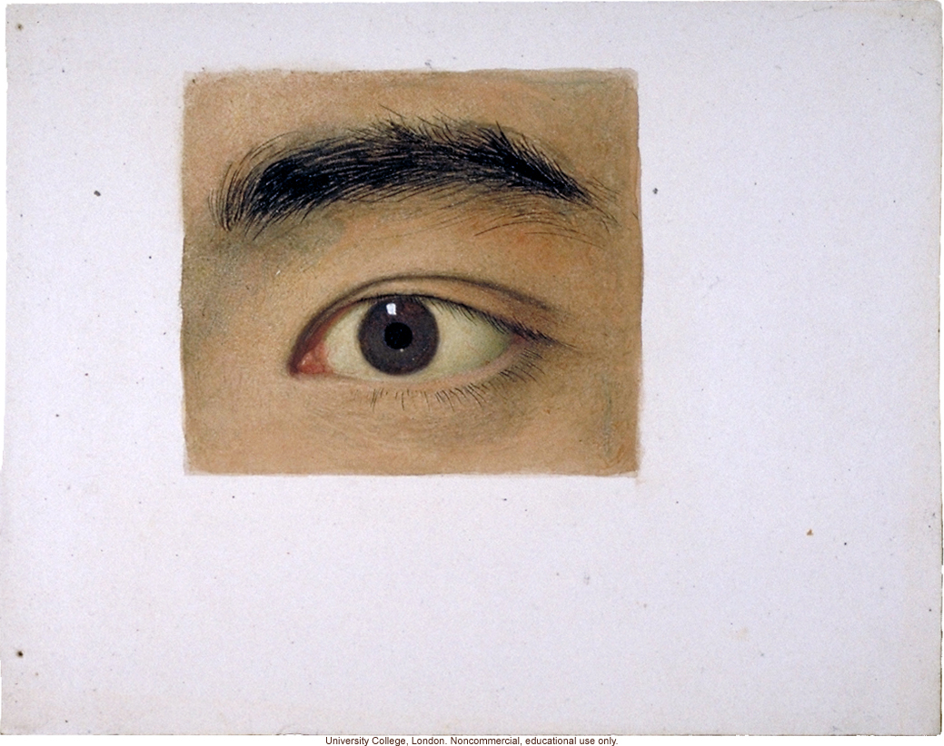Normal and albino human eyes, for publication in &quote;Albinism in Man,&quote; by K. Pearson, E. Nettleship, and C.H. Usher (1911)
