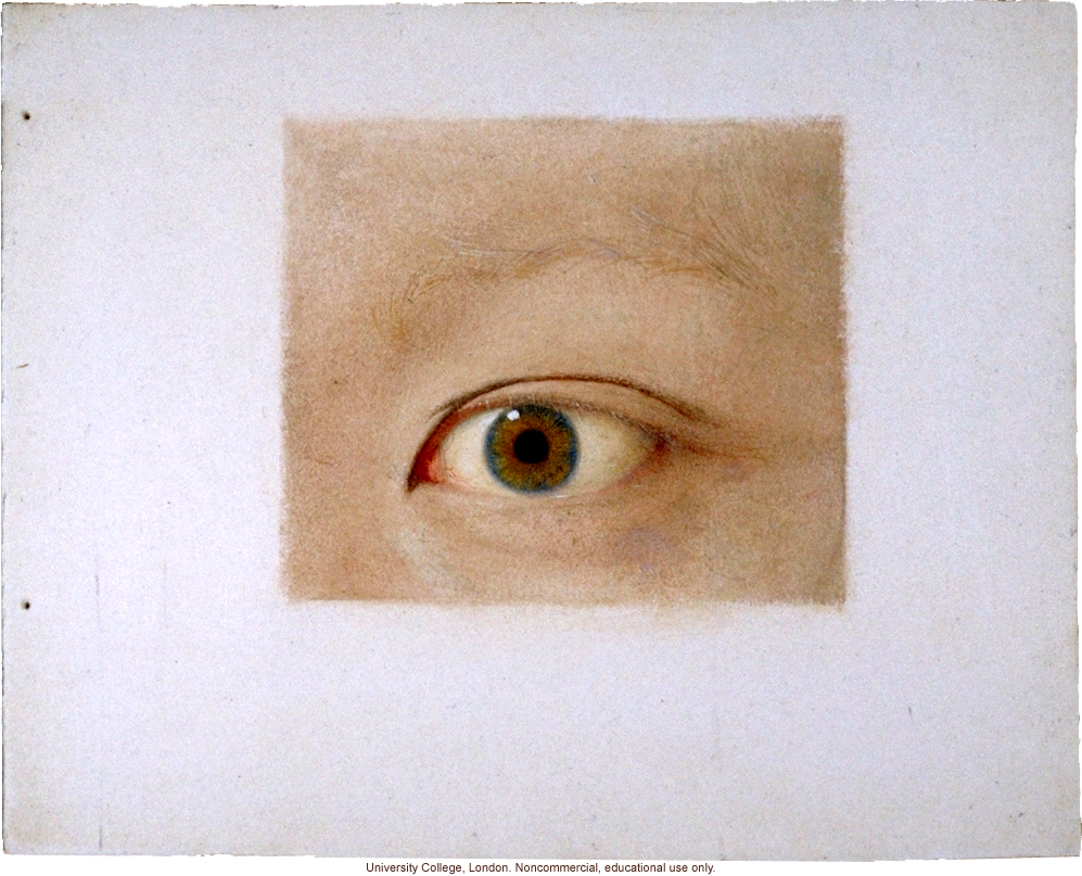Normal and albino human eyes, for publication in &quote;Albinism in Man,&quote; by K. Pearson, E. Nettleship, and C.H. Usher (1911)
