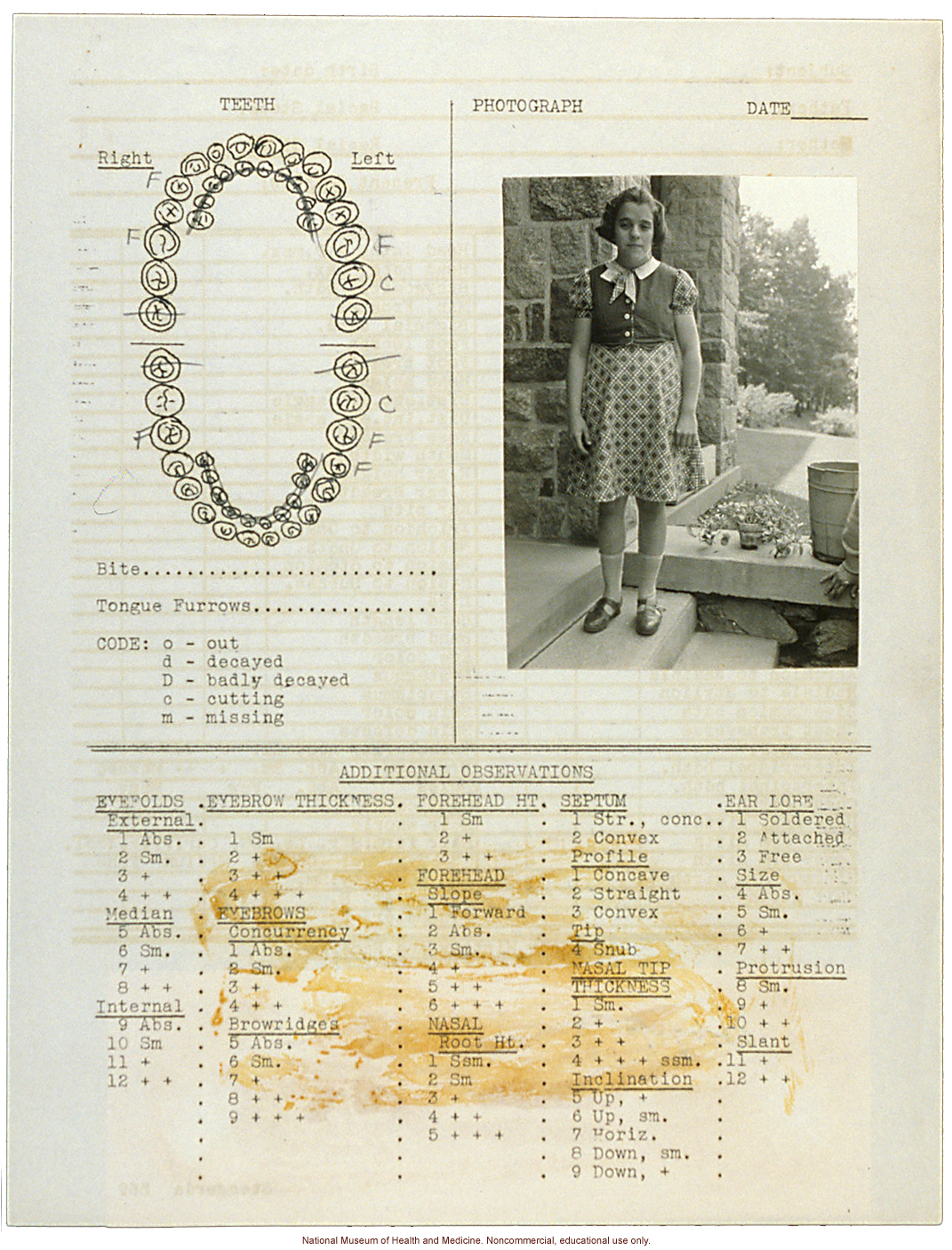 Anthropometry of Dwarves at Letchworth Village for the Feebleminded and Epileptic (measurements, family histories, dental charts, and photographs)