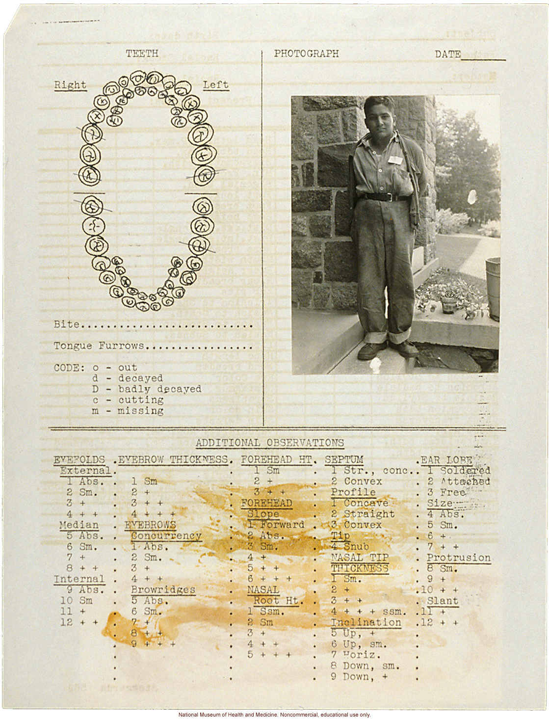 Anthropometry of Dwarves at Letchworth Village for the Feebleminded and Epileptic (measurements, family histories, dental charts, and photographs)