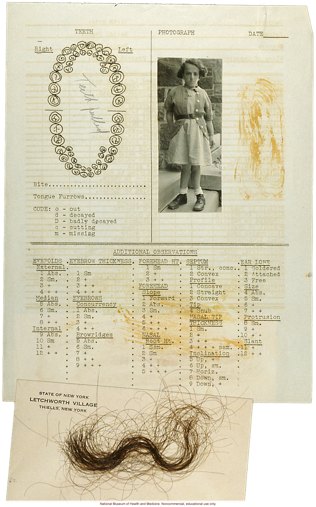 Anthropometry of Dwarves at Letchworth Village for the Feebleminded and Epileptic (measurements, family histories, dental charts, and photographs)