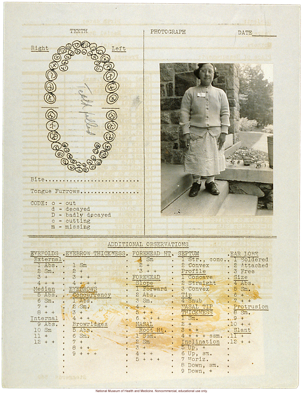 Anthropometry of Dwarves at Letchworth Village for the Feebleminded and Epileptic (measurements, family histories, dental charts, and photographs)