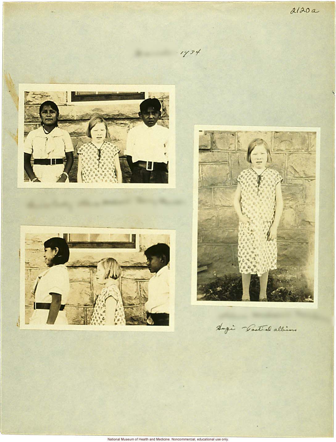 &quote;Growing Series&quote; of partial albino Hopi Female age 10-16, Ganado, Arizona (anthropometry, dental charts, and photographs)