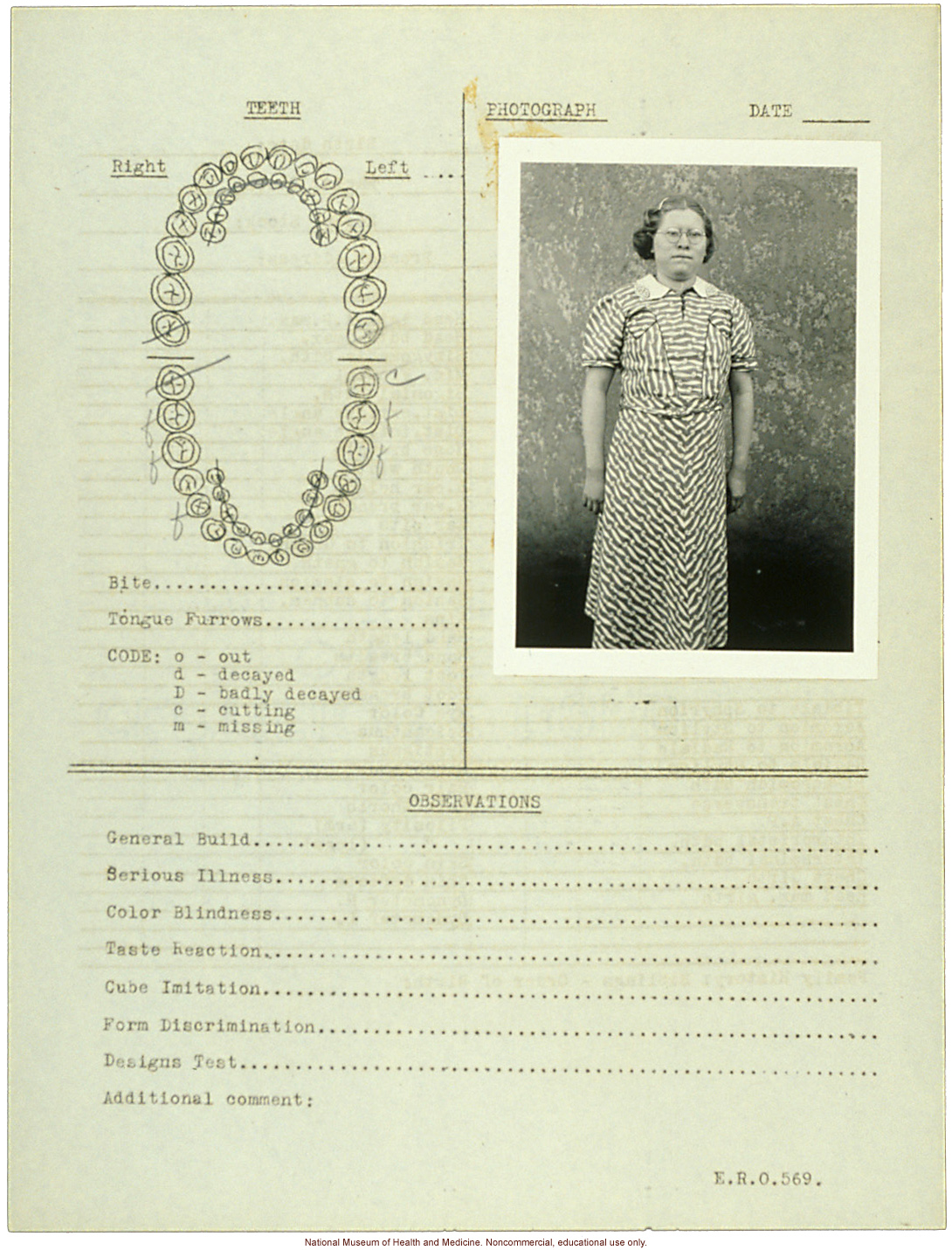 &quote;Growing Series&quote; of partial albino Hopi Female age 10-16, Ganado, Arizona (anthropometry, dental charts, and photographs)