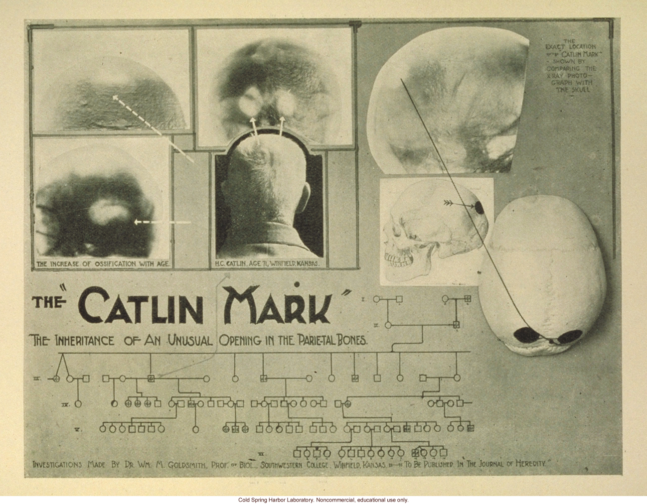 &quote;The Catlin Mark, the inheritance of an unusual opening in the parietal bones&quote;