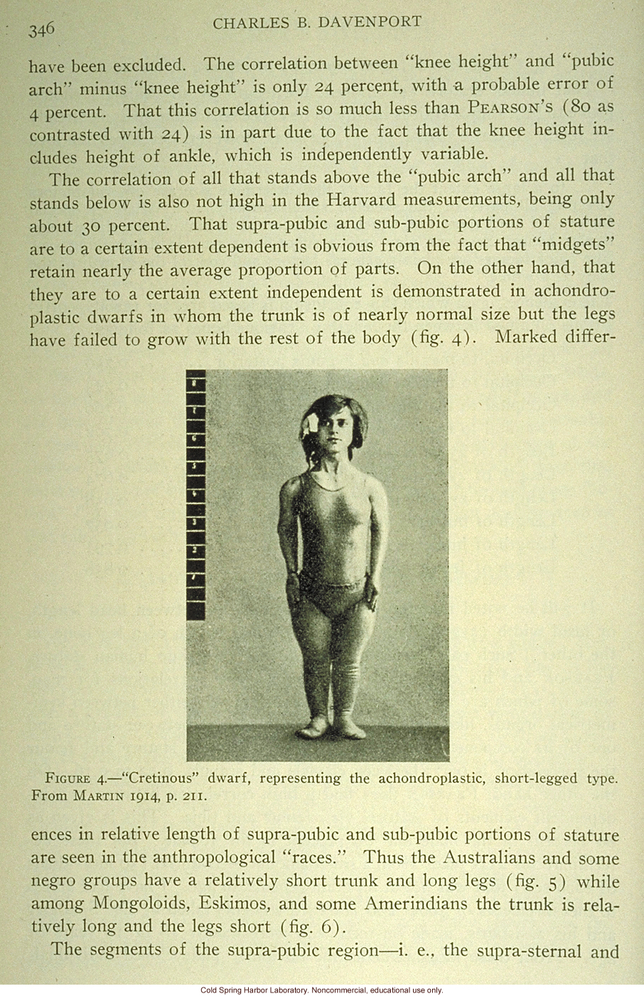&quote;'Cretinous' dwarf, representing the achondroplastic, short-legged type,&quote;
