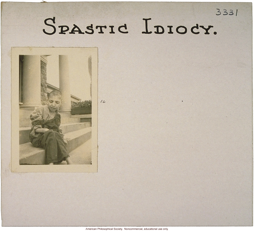 &quote;Spastic idiocy,&quote; flash cards on genetic defects