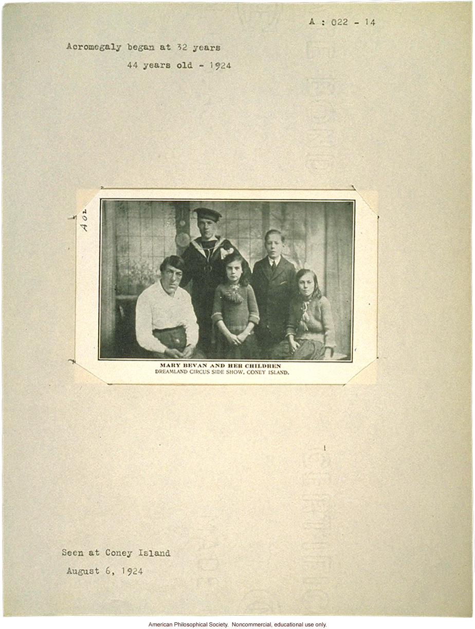 &quote;Mary Bevan and her children,&quote; acromegaly