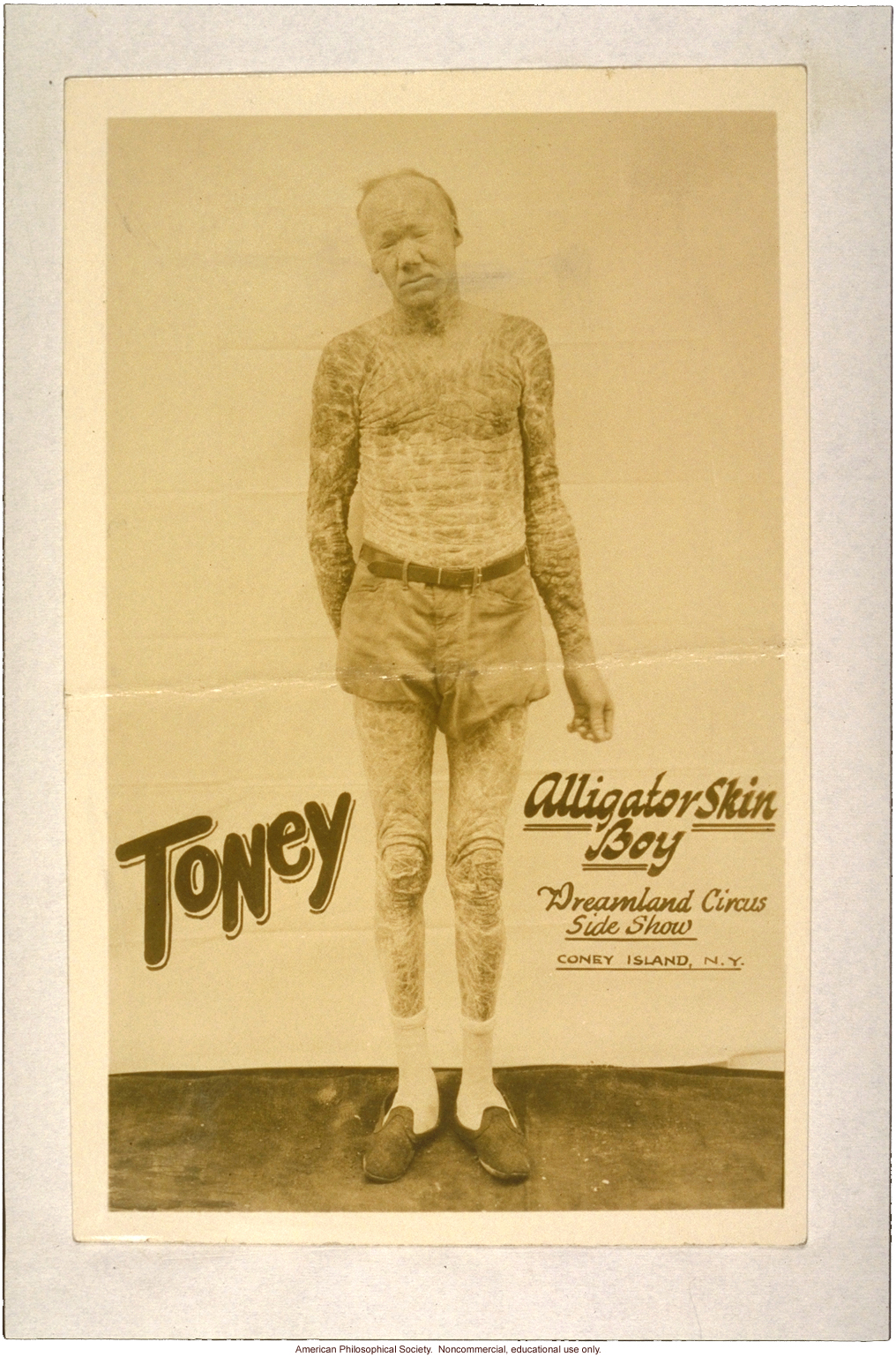&quote;Toney, alligator skin boy, Dreamland Circus side show, Coney Island,&quote; with icthyosis a skin trait