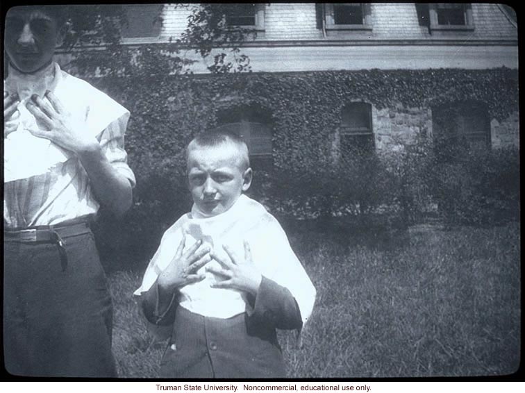 Two boys with polydactyly.