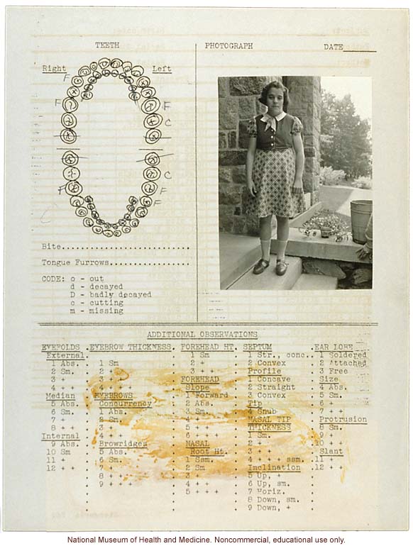 Anthropometry of Dwarves at Letchworth Village for the Feebleminded and Epileptic (measurements, family histories, dental charts, and photographs)