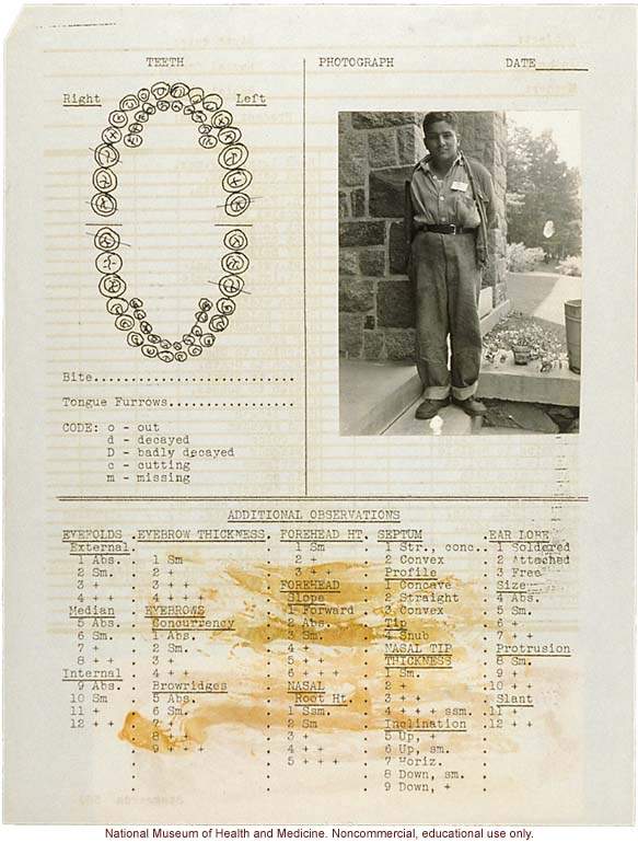 Anthropometry of Dwarves at Letchworth Village for the Feebleminded and Epileptic (measurements, family histories, dental charts, and photographs)