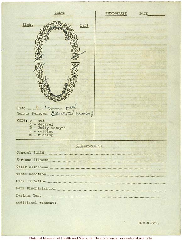 &quote;Growing Series&quote; of partial albino Hopi Female age 10-16, Ganado, Arizona (anthropometry, dental charts, and photographs)