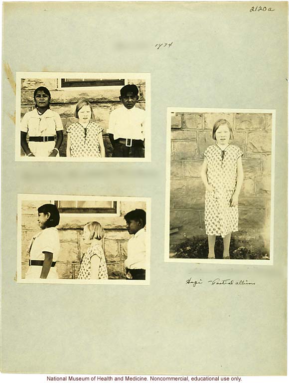 &quote;Growing Series&quote; of partial albino Hopi Female age 10-16, Ganado, Arizona (anthropometry, dental charts, and photographs)