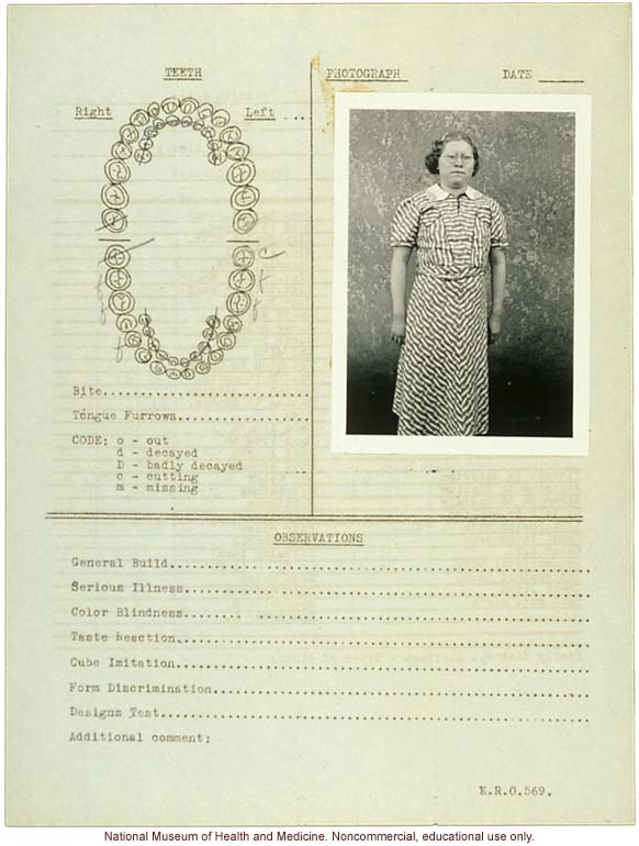 &quote;Growing Series&quote; of partial albino Hopi Female age 10-16, Ganado, Arizona (anthropometry, dental charts, and photographs)