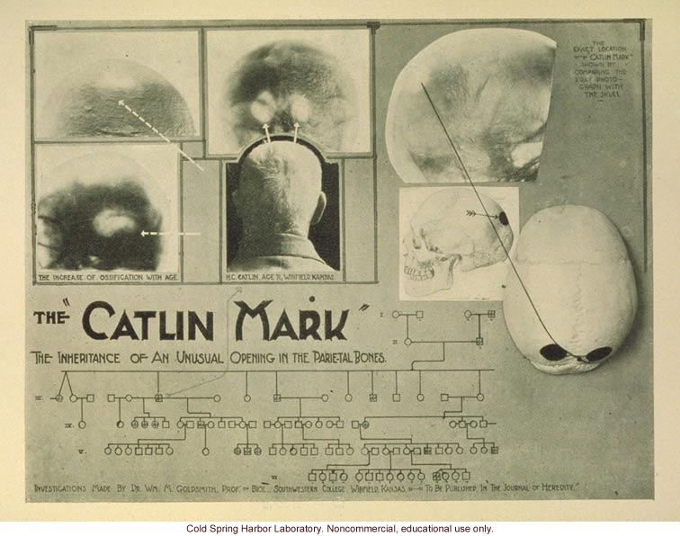 &quote;The Catlin Mark, the inheritance of an unusual opening in the parietal bones&quote;