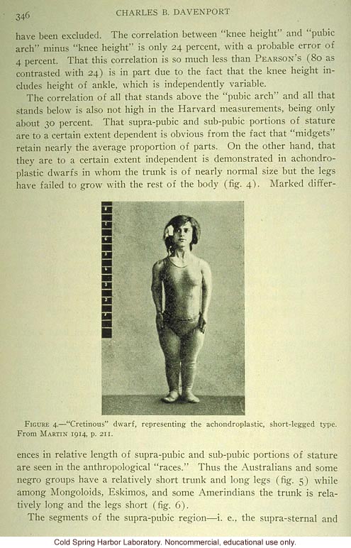 &quote;'Cretinous' dwarf, representing the achondroplastic, short-legged type,&quote;