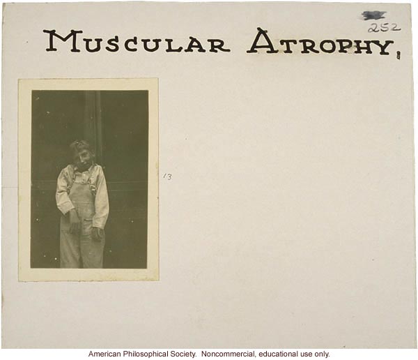 &quote;Muscular atrophy,&quote; flash cards on genetic defects