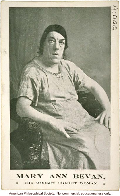 &quote;Mary Ann Bevan, the world's ugliest woman,&quote; acromegaly