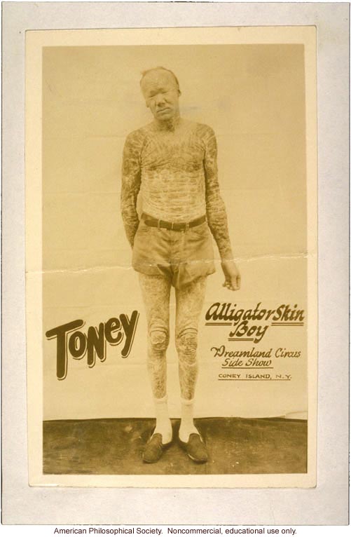 &quote;Toney, alligator skin boy, Dreamland Circus side show, Coney Island,&quote; with icthyosis a skin trait